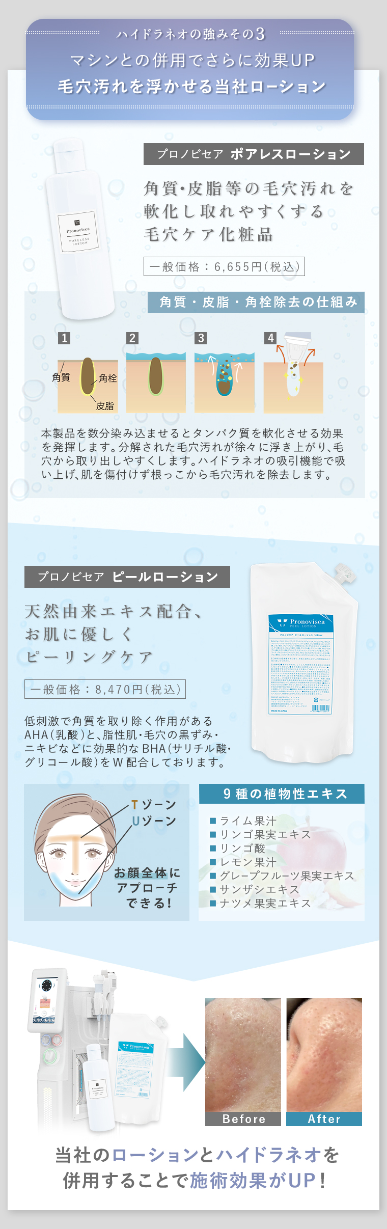 ハイドラネオの強みその3 マシンとの併用でさらに効果UP！毛穴汚れを浮かせる当社ローション